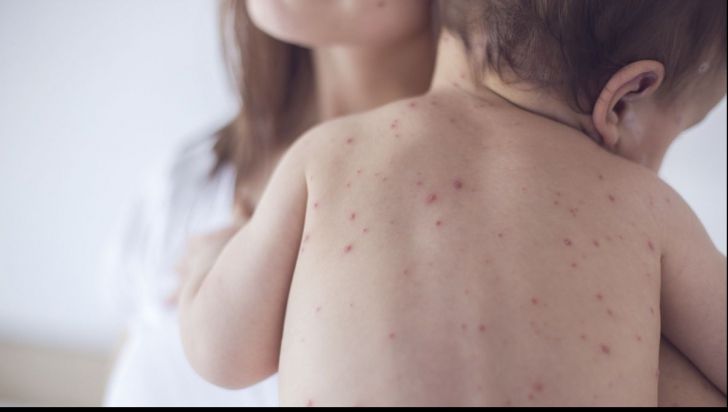 51 de cazuri noi de rujeolă confirmate în județul Suceava, în ultima săptămână