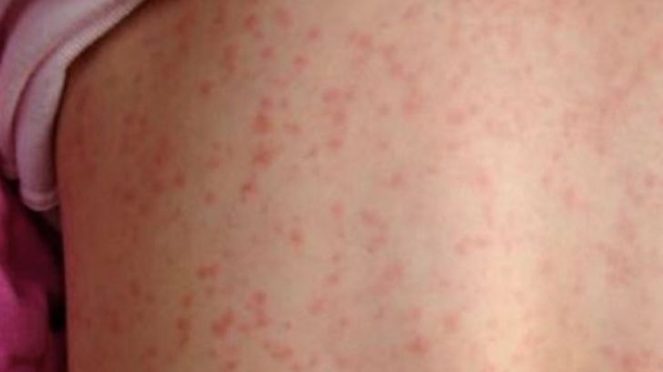 Alte 53 de cazuri de rujeolă au fost înregistrate în ultima săptămâna. Cele mai multe îmbolnăviri înregistrate în județul Suceava