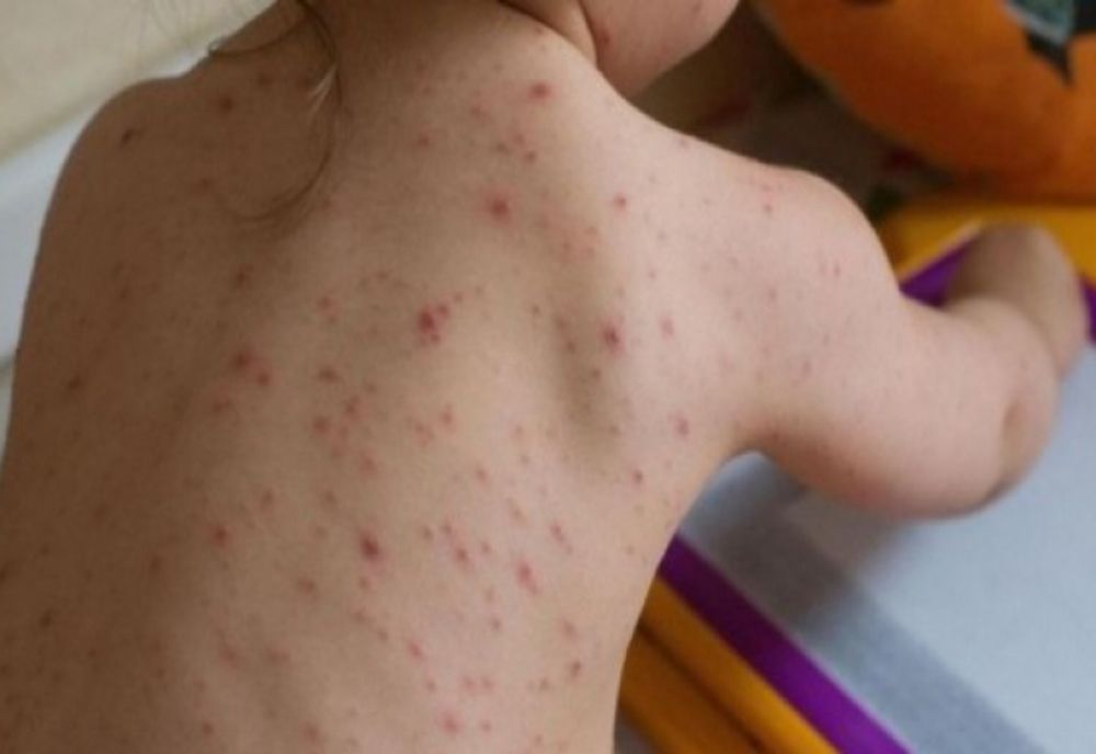 Suceava, locul întâi pe țară la numărul cazurilor de rujeolă