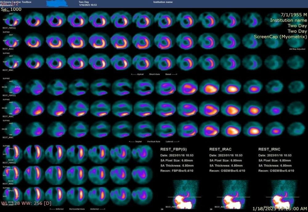 Scintigrafie miocardică de perfuzie cu dispozitiv hibrid spect/ct – tehnică imagistică folosită în premieră pentru regiunea Moldovei la Spitalul Județean Suceava