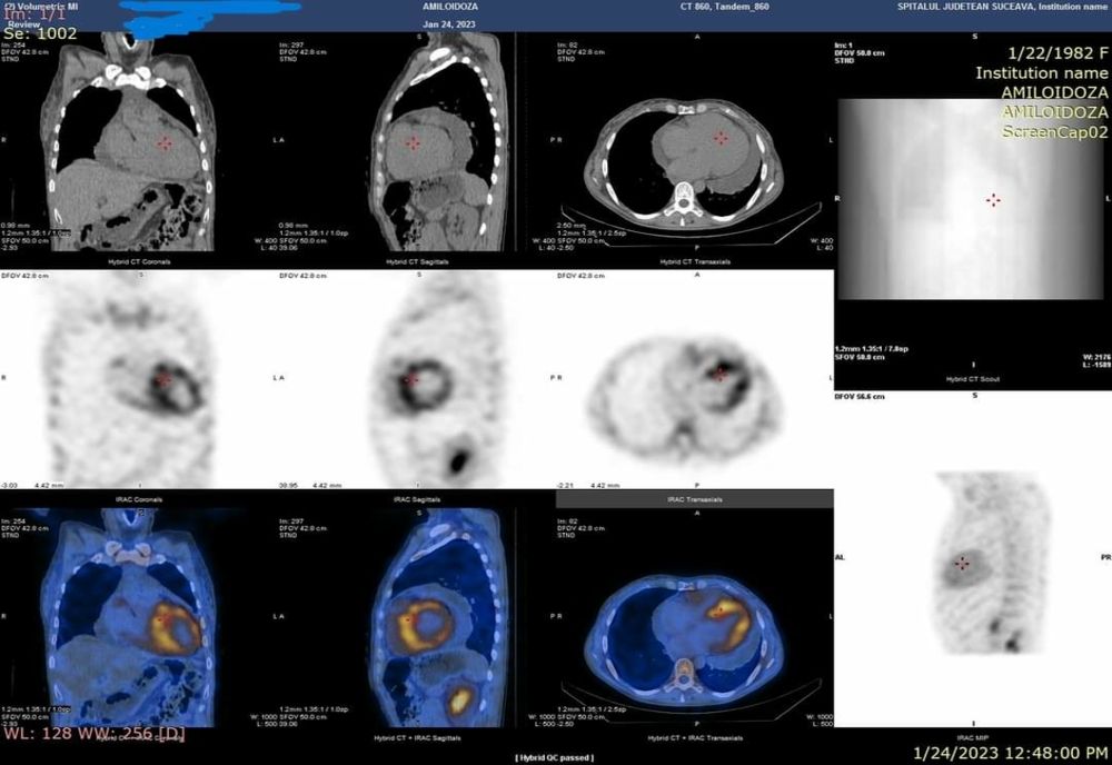 O nouă investigație modernă accesibilă în SJU. Scintigrafia cu difosfonați, metodă pentru diagnosticul amiloidozei ereditare