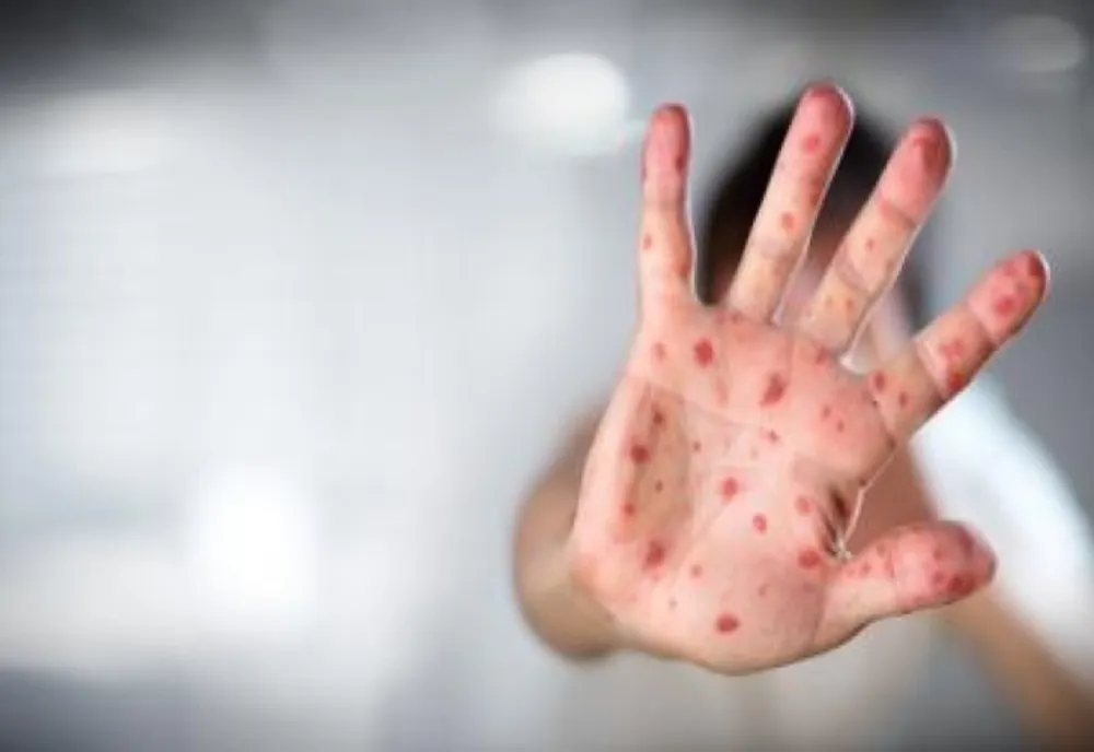15 cazuri noi de rujeolă, confirmate în ultima săptămână în județul Suceava