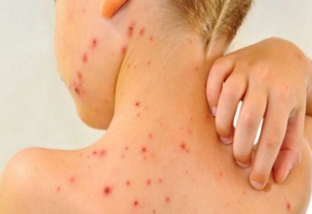 Suceava, din nou pe primul loc în țară la numărul de cazuri de rujeolă nou confirmate