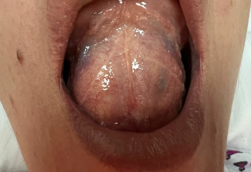 Chist voluminos îndepărtat de echipa secției BMF a Spitalului Județean