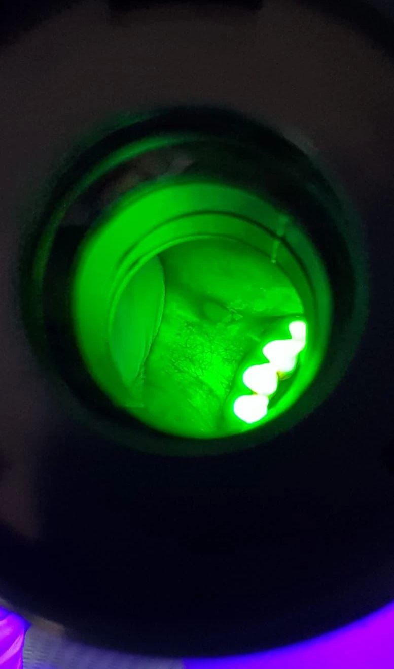 Screening gratuit pentru depistarea cancerului oral, lansat la Spitalul Județean Suceava