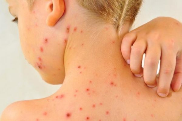 Noi cazuri de rujeolă, confirmate în ultima săptămână, la Suceava