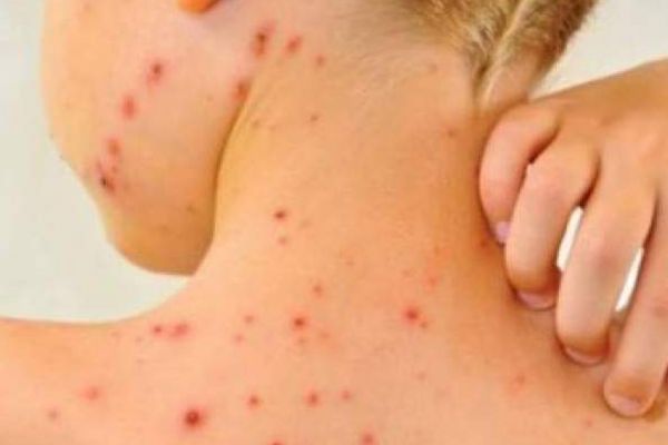 37 de cazuri noi de rujeolă au fost confirmate în ultimele cinci zile în județul Suceava