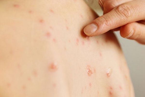 În luna mai s-au înregistrat 87 de cazuri de rujeolă în județul Suceava