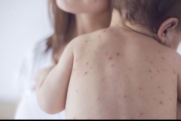 51 de cazuri noi de rujeolă confirmate în județul Suceava, în ultima săptămână