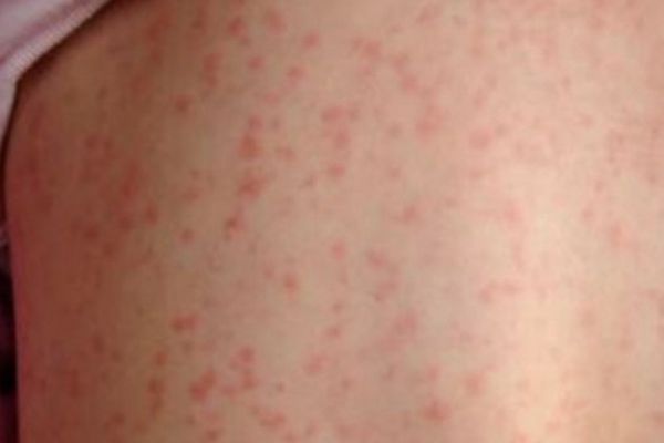 Alte 53 de cazuri de rujeolă au fost înregistrate în ultima săptămâna. Cele mai multe îmbolnăviri înregistrate în județul Suceava