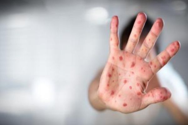 15 cazuri noi de rujeolă, confirmate în ultima săptămână în județul Suceava