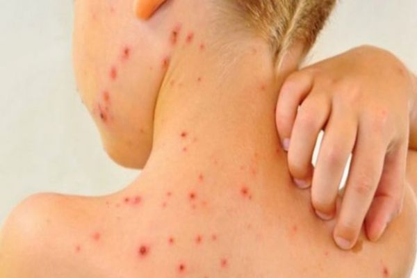 Județul Suceava, pe locul întâi în țară la numărul cazurilor de rujeolă