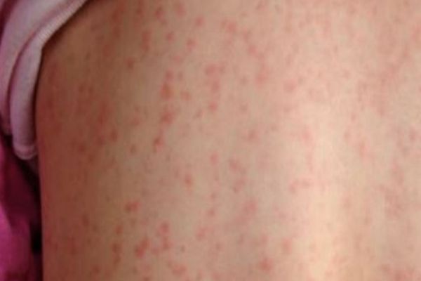 21 de cazuri noi de rujeolă raportate în județul Suceava în ultimele cinci zile 