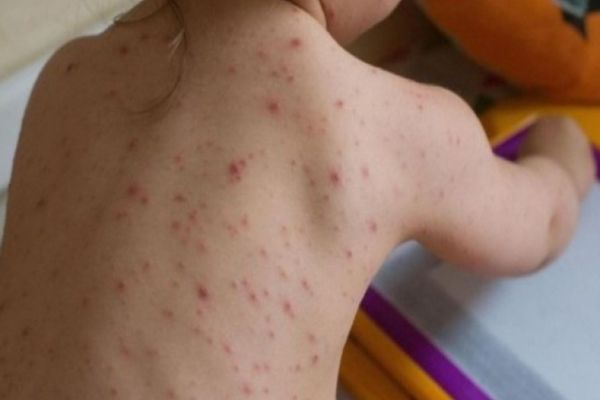 Suceava, locul întâi pe țară la numărul cazurilor de rujeolă