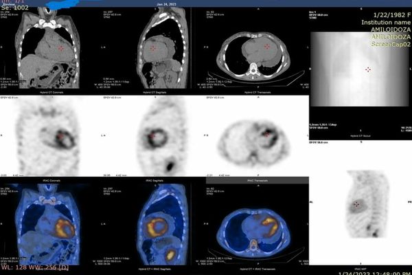 O nouă investigație modernă accesibilă în SJU. Scintigrafia cu difosfonați, metodă pentru diagnosticul amiloidozei ereditare