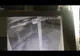 VIDEO Accidentul rutier grav de la Vicovu de Jos, suprins de o cameră de supraveghere